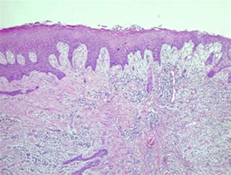 Cureus Peripheral Ossifying Fibroma Evolved From Pyogenic Granuloma