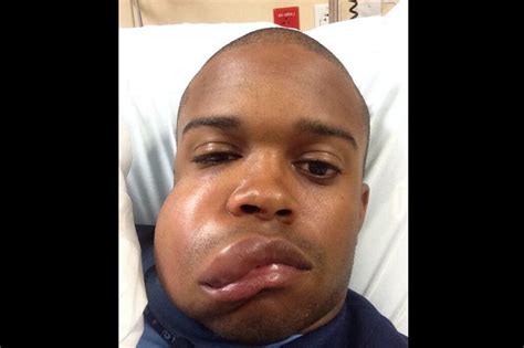 Delino Deshields Jr Shows Off Swollen Face After Being Hit By 90 Mph