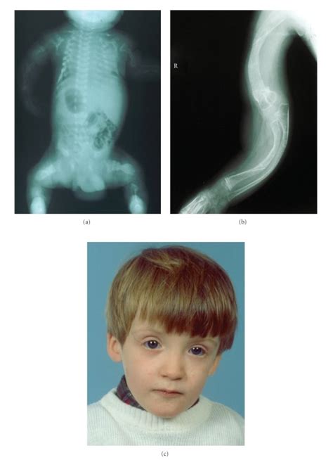 Clinical Features Of Osteogenesis Imperfecta Osteopenia And Multiple Download Scientific