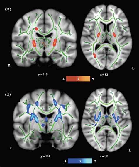 Anoxic Brain Injury Research Imaging