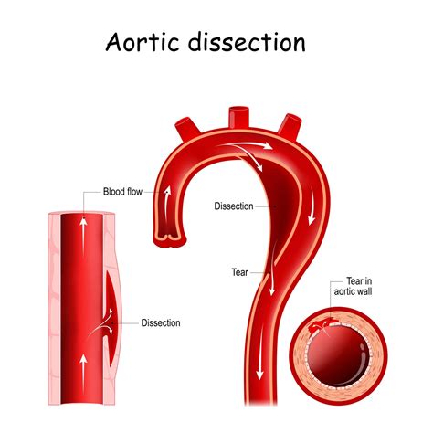 Dissection Aortique Causes Symptômes Traitements