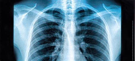 Cancer Risk From Increased Exposure From X Ray Radiation