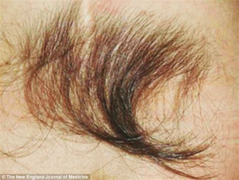 Tuft Of Thick Hair On Three Year Old Girls Back Reveals A Hidden