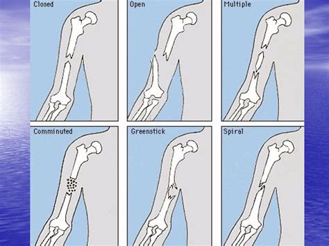 Osteoarticular Trauma Ppt Download