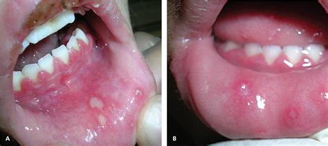 Oral Herpes Gums
