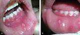 The first type usually cause the appearance of painful sores and blisters on the lips and in the mouth, when the virus of the second type these lesions. Fever Blister - Causes, Stages, Treatment & Home Remedies