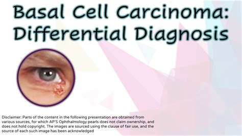 Basal Cell Carcinoma Differential Diagnosis Youtube