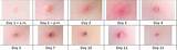 Shingles Recovery Period Images