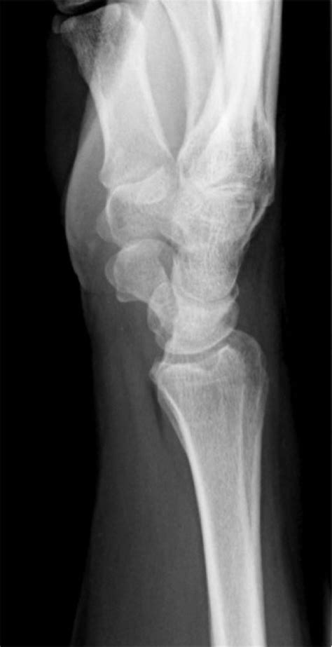 X Ray Wrist Lateral View