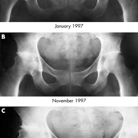 Plain Radiographs Of The Hips Patient 3 A January 1997 B