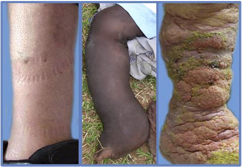 Lymphedema And Subclinical Lymphostasis Microlymphedema Facilitate