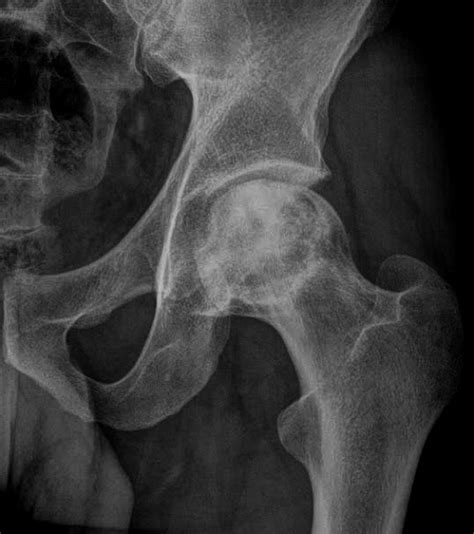 Traumatic and nontraumatic causes can lead to an insult to the blood supply of the joint. Avascular necrosis of the hip is more common than other ...