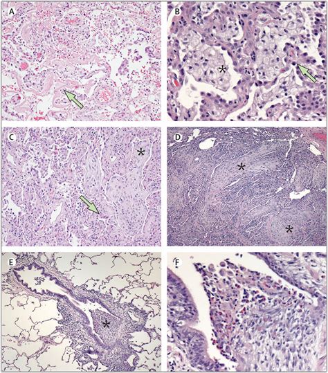 Histopathological Features Of Lung Biopsies Submitted For The