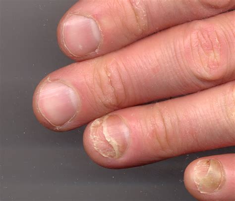 Nail Clinic Onycholysis What It Looks Like Causes And Treatment