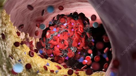 Blood Clot Illustration Stock Image F0349715 Science Photo Library