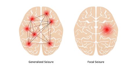 understanding different kinds of seizures nih medlineplus magazine