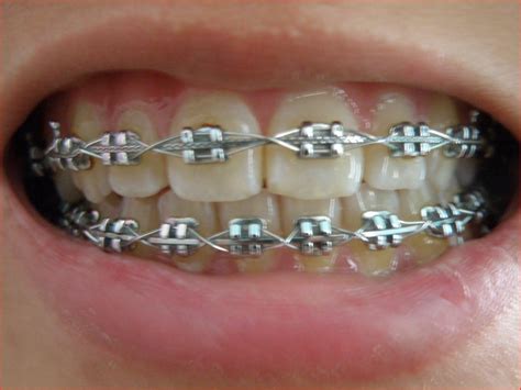 Pin By Nakesha Campbell On Braces To Get Orthodontics Braces Dental