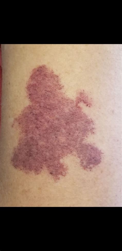 Birthmark On My Left Upper Arm Birthmark Tattoo Birthmark Maple