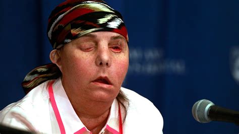 Face Transplant Recipients Donor Face Has Been Failing Doctors Say Fox News