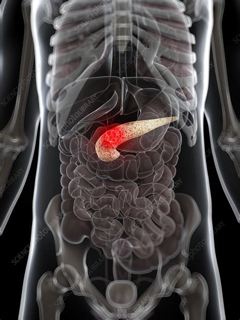 Symptoms of pancreatic cancer include stomach and back pain, weight loss, bloating, diarrhea, and more, which are often missed or attributed to other conditions, which leads to diagnosis with. Pancreatic cancer, artwork - Stock Image - F006/7998 ...