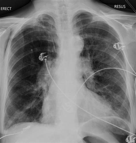 Apical Pneumothorax Chest X Ray