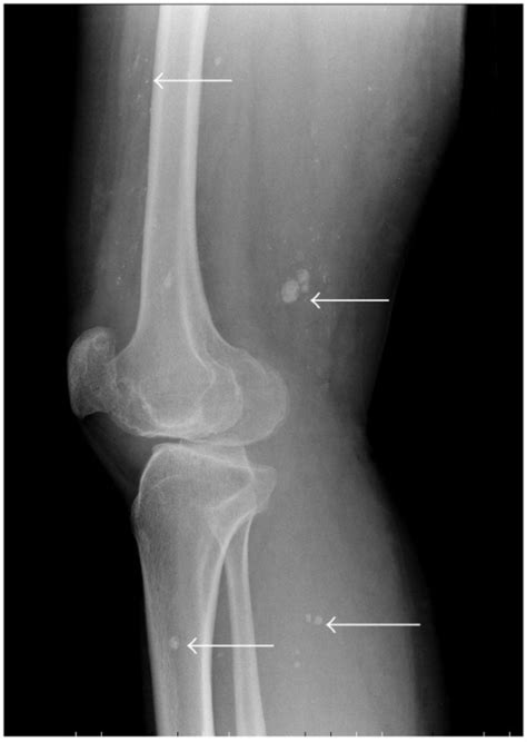 Lateral Radiograph Of The Knee Demonstrating Multiple V Open I