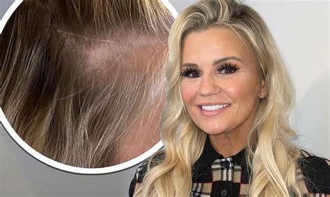 Kerry Katona Reveals Shes Going Bald After Years Of Extensions Left