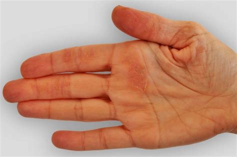 These Are The Diseases Your Hands Can Predict The Healthy