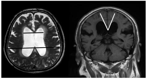 Jcm Free Full Text Dopaminergic Degeneration And Small Vessel