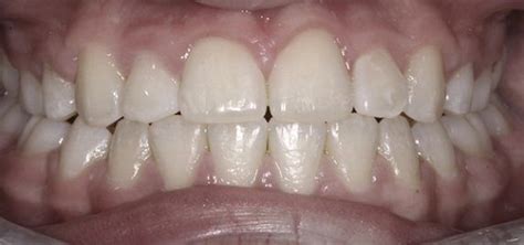 Braces Before And After Invisalign Results Splash Orthodontics