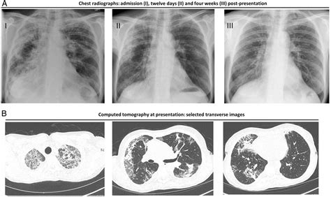 Levetiracetam Induced Eosinophilic Pneumonia Bmj Case Reports