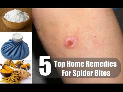 5 Home Remedies for Spider Bites | By Top 5. 
