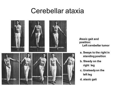 Cerebeller Ataxia Causesymptomsdiagnosis Physiotherapy Treatment