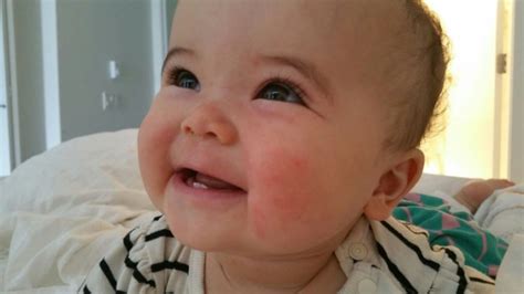 Food Allergy Skin Rush On Babys Face September 2015 Babycenter