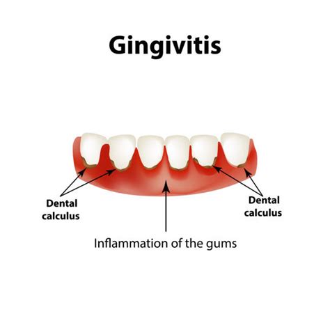 Gingivitis Illustrations Royalty Free Vector Graphics And Clip Art Istock
