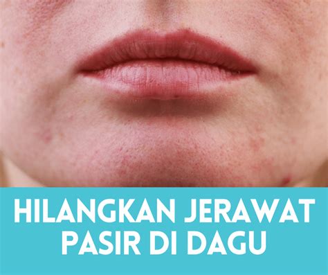 Cara Menghilangkan Jerawat Pasir Di Dahi Dagu And Pipi • Portal