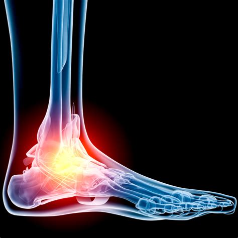 Tendonitis Foot And Ankle Doctors Inc