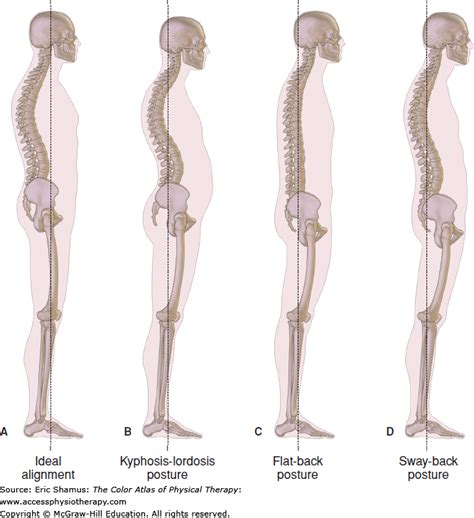 Body Postures Part 3 Kyphosis