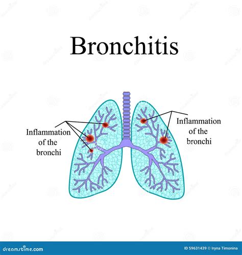 Bronchitis The Anatomical Structure Of The Human Stock Vector
