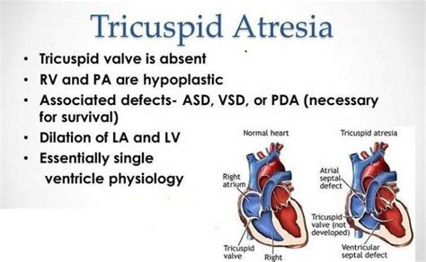 Tricuspid Atresia Medizzy