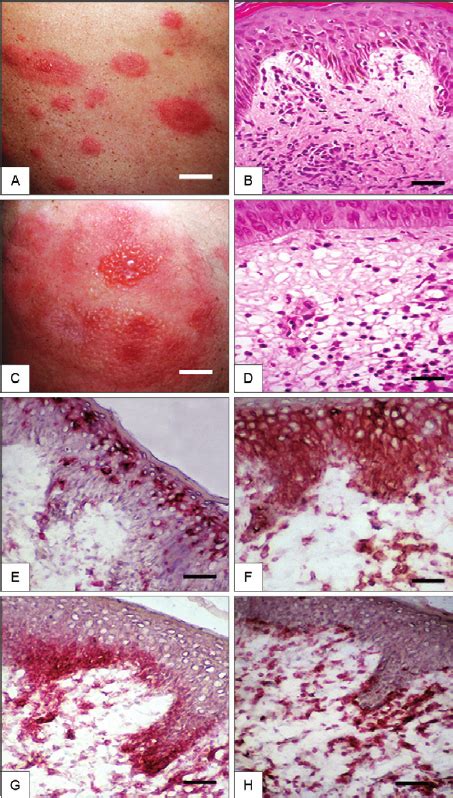 Clinical Lesions Of Erythema Multiforme Em Correlate With