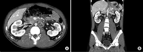 Contrast Abdomen And Pelvic Ct Scan A Transverse Ct Section Showed