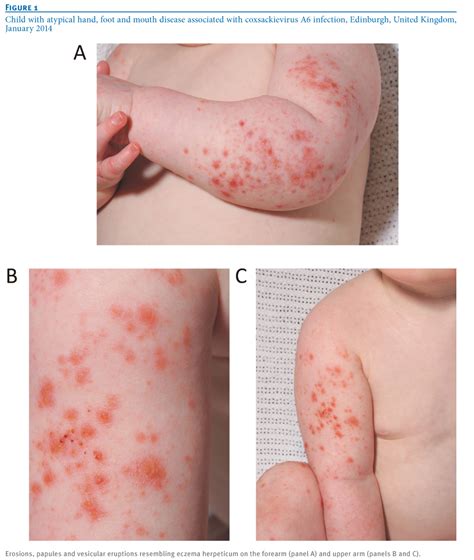 eurosurveillance atypical hand foot and mouth disease associated with coxsackievirus a6