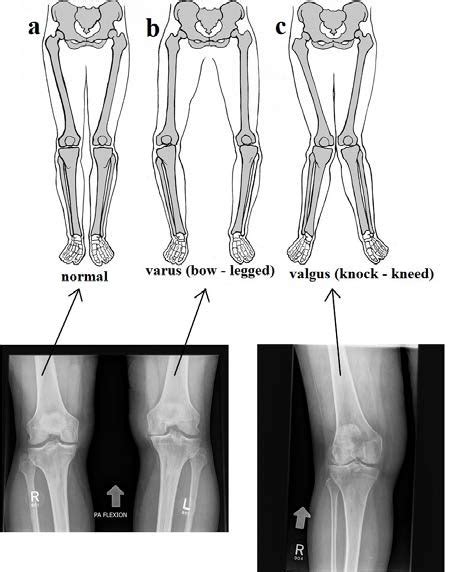 The Images Show A Normal Knee Alignment A Varus Bowed Legs B And