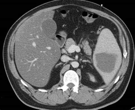 Isolated Splenic Abscess Due To Salmonella Berta In A Healthy Adult