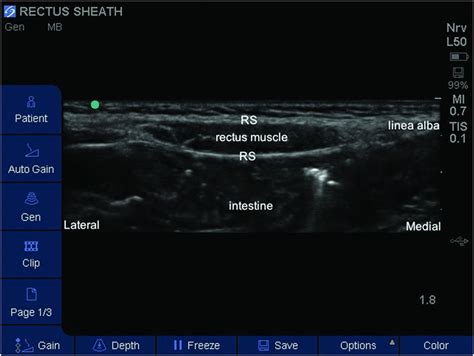 Rectus Diastasis Ultrasound