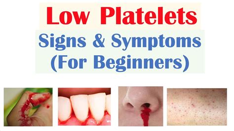 Low Platelets Signs And Symptoms Basics For Beginners Youtube
