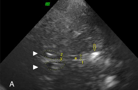 4th Ventricle Ultrasound
