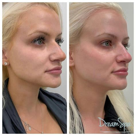 Face Volumetry Advanced Dermal Filler Cheek Jaw Chin Training