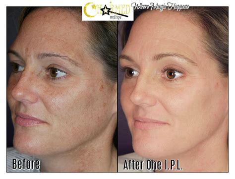 Ipl Everything You Need To Know About Intense Pulsed Light Charmed